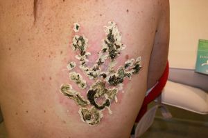An alternative to laser tattoo removal is the Rejuvi tattoo removal ...